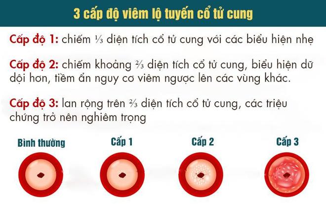 3 cấp độ viêm lộ tuyến cổ tử cung