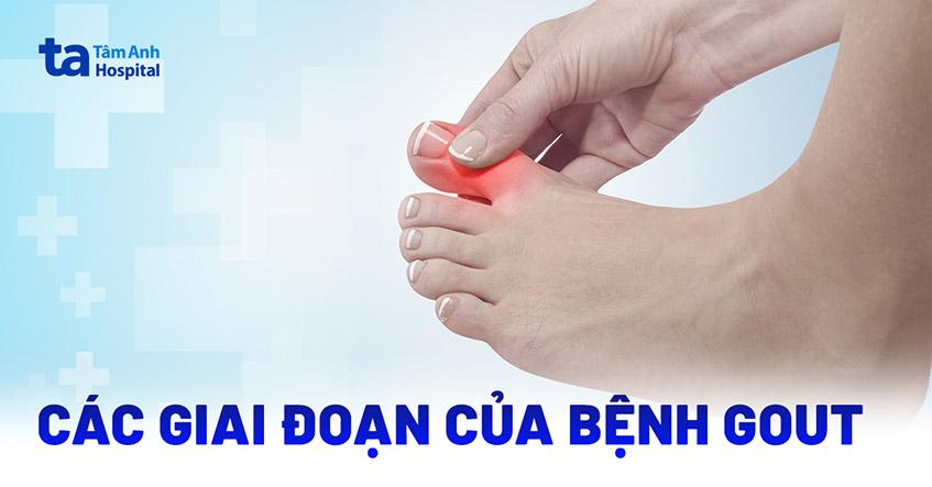 các giai đoạn của bệnh gout