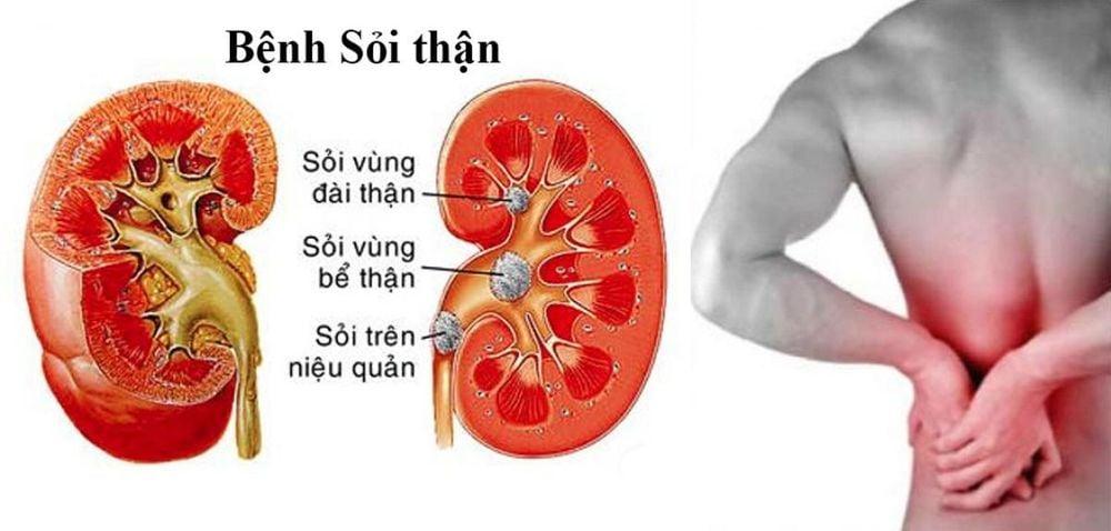 Sỏi thận hình thành như thế nào?