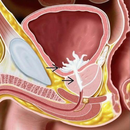 Tinh dịch loãng có nước: Nguyên nhân do đâu và ảnh hưởng đến khả năng sinh sản không?