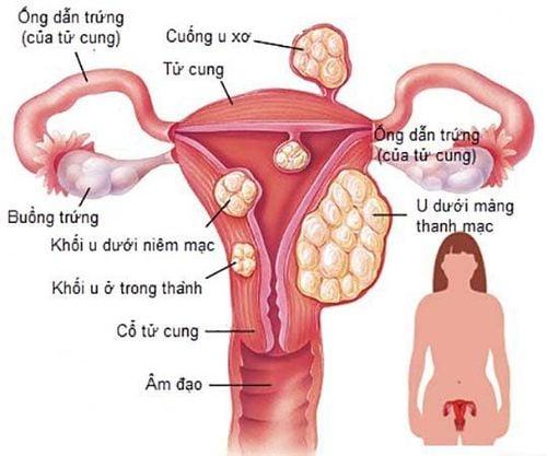 Phân biệt u lành tính và u ác tính