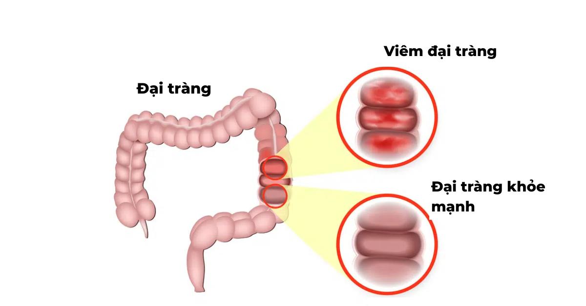 Hình ảnh viêm đại tràng