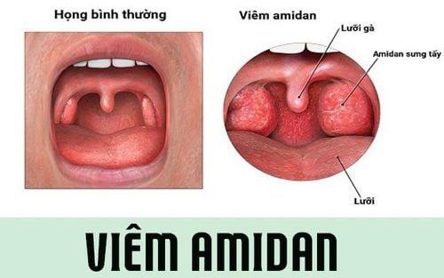 Loạn cảm họng (nuốt vướng vùng cổ họng) điều trị như thế nào?