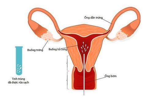 Băn khoăn về chỉ số beta hcg sau IUI