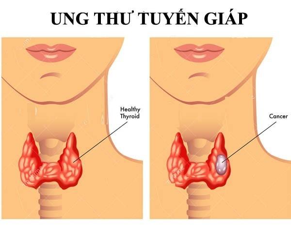 bị ung thư tuyến giáp nên kiêng gì?